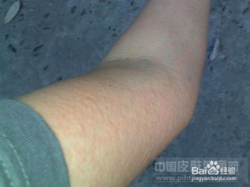 顽固性荨麻疹 挑战与综合治疗方案