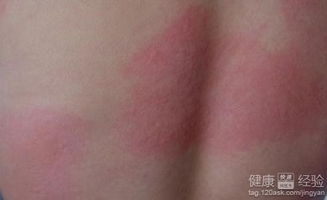 应对荨麻疹 实用指南与舒缓建议