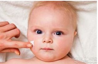 新生儿湿疹与荨麻疹 能否使用郁美净及家长须知