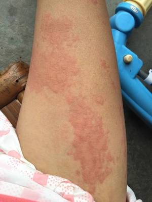 荨麻疹 症状、病因与应对策略